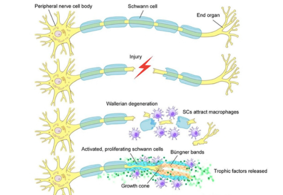 Peripheral Nerve Palsy Treatment in Mumbai